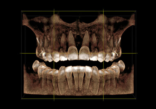 3D visualization of a computer tomogram of the dentition, front view